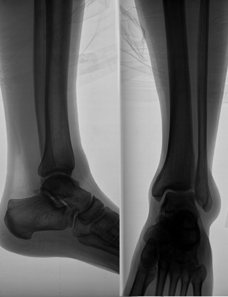 X-ray image of the leg
